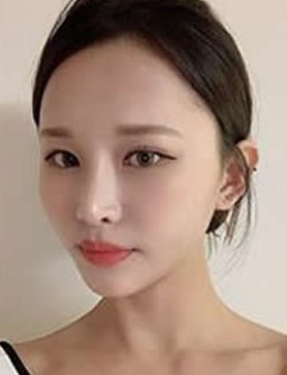韩国秀美颜眼鼻修复真人照片展示！