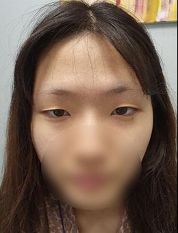 韩国歌娜医院眼综合整形真人分享，前后对比告诉你她做了哪几项手术！