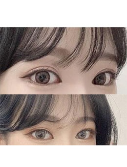 韩国歌娜整形医院眼修复前后对比，术后形态标配女团眼！
