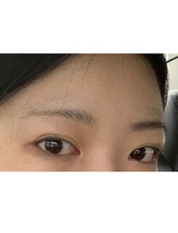 韩国歌娜整形医院眼修复前后对比，术后形态标配女团眼！_术前