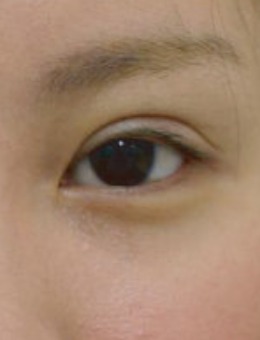 日本哪家双眼皮做得好，银座Miyuki美幸整形外科水谷和则做的怎么样！_术前