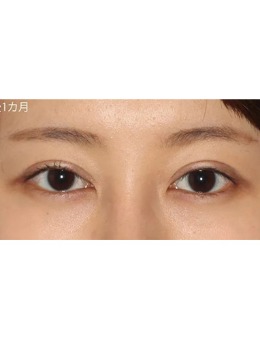 日本Ritz美容医院眼部整形手术对比
