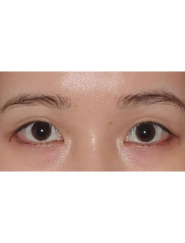 日本Ritz美容整形眼部修复手术案例对比