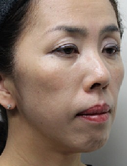玻尿酸填充脸会垮吗？日本Takami整形玻尿酸注射全脸前后对比案例分享！