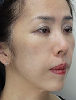 -玻尿酸填充脸会垮吗？日本Takami整形玻尿酸注射全脸前后对比案例分享！