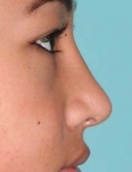 日本Lira Cranio面部诊所驼峰鼻改善案例