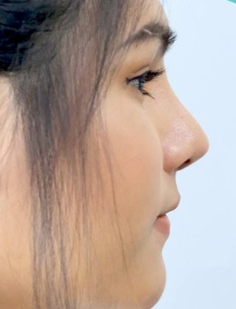 -泰国KTOP整形外科鼻部整形手术日记