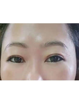 -泰国KTOP整形外科眼部整形对比