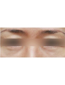 泰国ktop整形医院眼底脂肪重置案例图