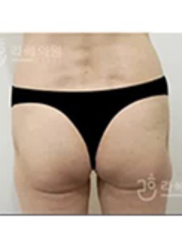 韩国HEHAE整形外科自体脂肪丰臀案例