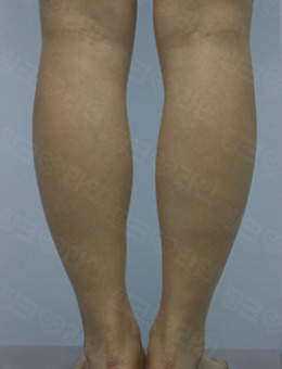 韩国pinkline皮肤科小腿塑形手术对比案例_术前