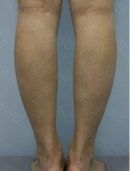 韩国pinkline皮肤科小腿塑形手术对比案例_术后