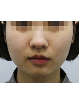韩国pinkline下颌缘吸脂前后对比_术前