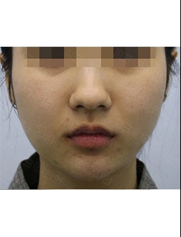 韩国pinkline下颌缘吸脂前后对比