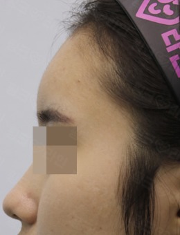 韩国pinkline皮肤医院额头填充案例图_术后