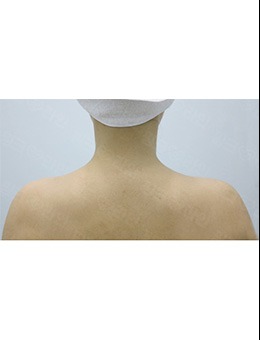 韩国pinkline皮肤科注射瘦肩针案例