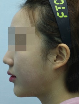 韩国pinkline皮肤医院下巴整形前后对比图