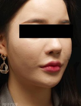 韩国丽迪安整形医院面部吸脂案例