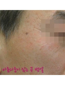 韩国bethel皮肤科医院面部祛斑手术案例图_术前