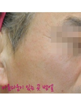 韩国bethel皮肤科医院面部祛斑手术案例图_术后