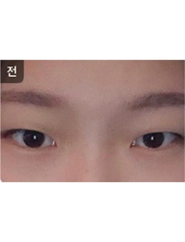 韩国Toptier整形医院眼部手术对比案例