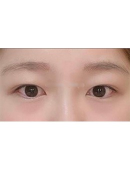 韩国Toptier整形外科眼修复手术日记_术前