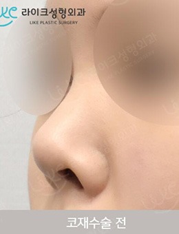 韩国来客like整形外科朝天鼻矫正前后对比案例