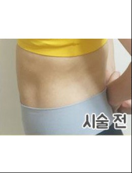 韩国iyou皮肤科医院腰腹注射溶脂针案例