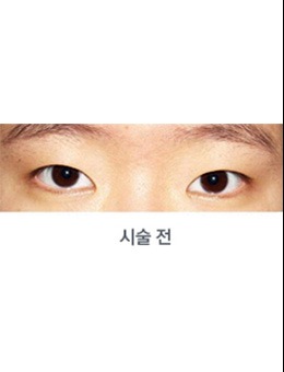 -韩国medicos皮肤整形外科双眼皮手术案例