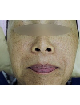 Medicos皮肤整形外科祛斑恢复过程
