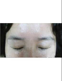 韩国medicos皮肤整形外科去眼角皱纹案例对比