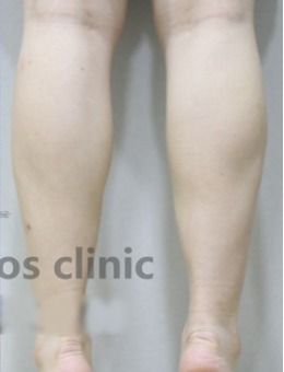 -韩国medicos皮肤整形外科小腿整形案例