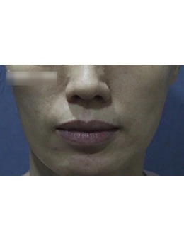 韩国新沙人皮肤科法令纹去除手术案例