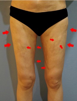 韩国丽迪安整形医院大腿吸脂修复案例