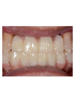 分享一组深圳鹏程医院口腔科牙齿缺失种植牙案例！