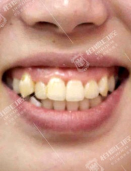 广州柏德口腔牙齿矫正效果怎么样？有图有真相！