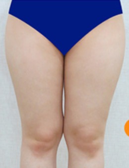韩国dr.creamy医院大腿+小腿吸脂案例前后对比图