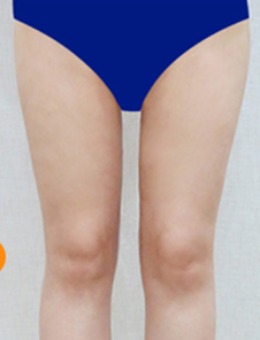 韩国dr.creamy医院大腿+小腿吸脂案例前后对比图