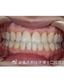 分享我在重庆韩佳牙博士做隐适美牙齿矫正的经历和价格