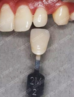 山东泰安雅美口腔牙齿修复牙贴片案例