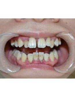 -分享我在重庆韩佳牙博士做隐适美牙齿矫正的经历和价格