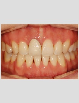 分享一组深圳世纪河山口腔医院牙齿矫正案例！