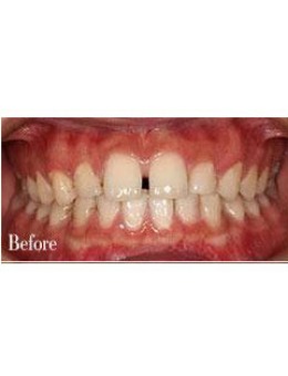 -分享一组深圳弘和口腔医院的隐形牙齿矫正案例!