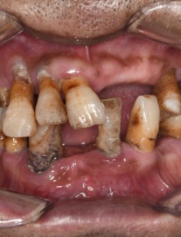 -鼎植口腔医院牙齿种植案例对比，美观又健康！