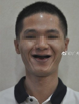 广州德系口腔牙齿正畸牙齿种植瓷贴面案对比价格合集