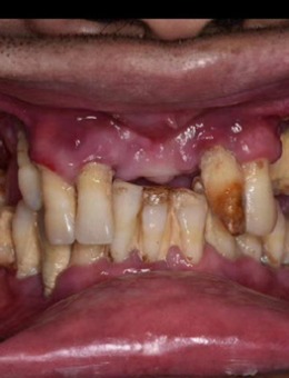在慈溪鼎植口腔门诊部做牙齿即刻种植后我终于远离了多年看牙的绝望