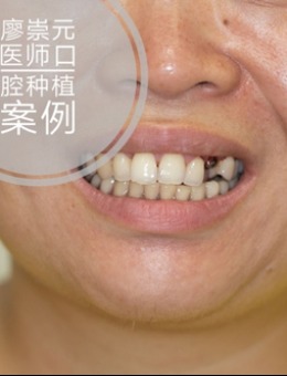 考察多家齿科医院后，我带妈妈去广州全家福口腔医院做了牙齿即刻种植（附详细流程）