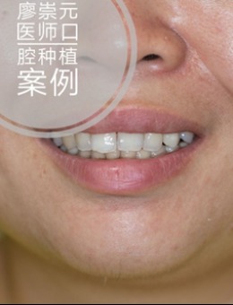 -考察多家齿科医院后，我带妈妈去广州全家福口腔医院做了牙齿即刻种植（附详细流程）