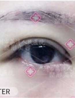 -广州荔湾人民医院做眼部多项手术效果好吗？真实案例在此！