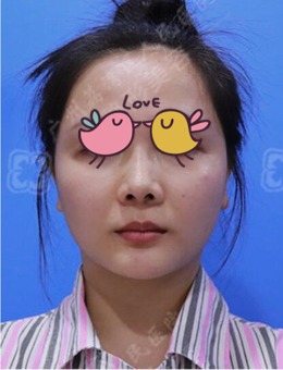 -做肋骨鼻后悔了？我在广州荔湾人民医院做的肋骨隆鼻非常满意！